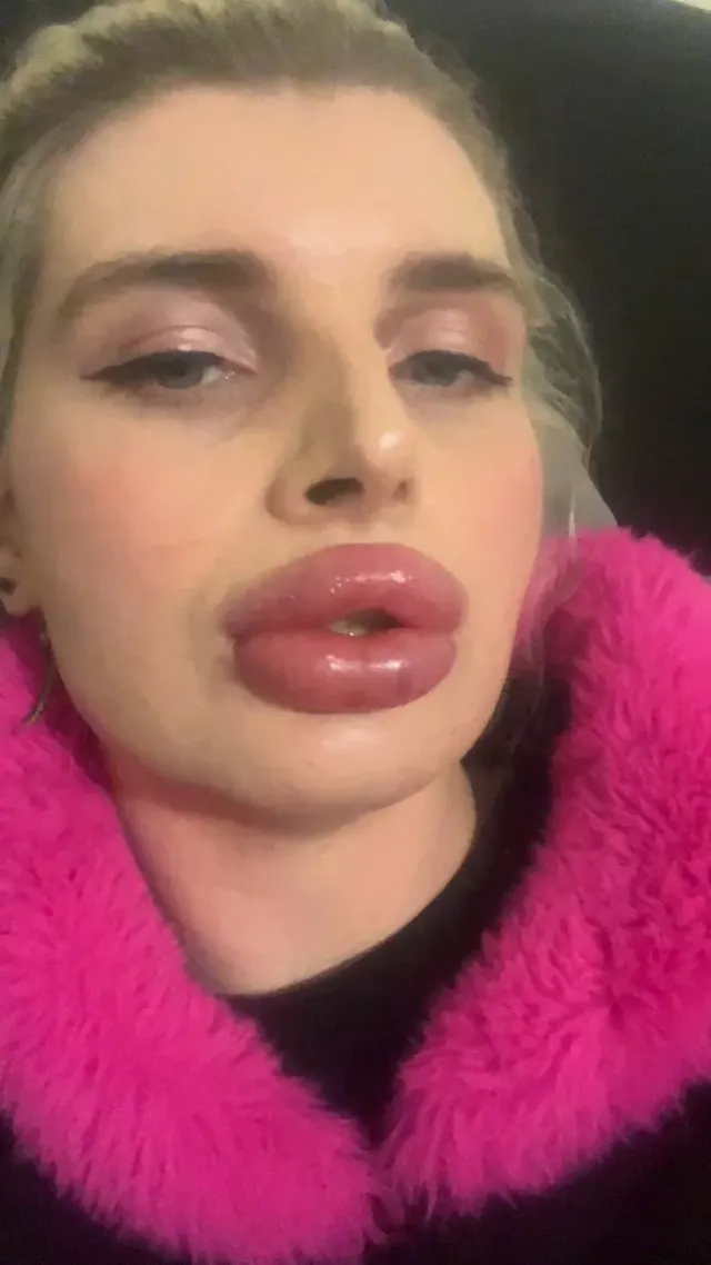 Freshly Filled and these bolt-on lips cannot close at all